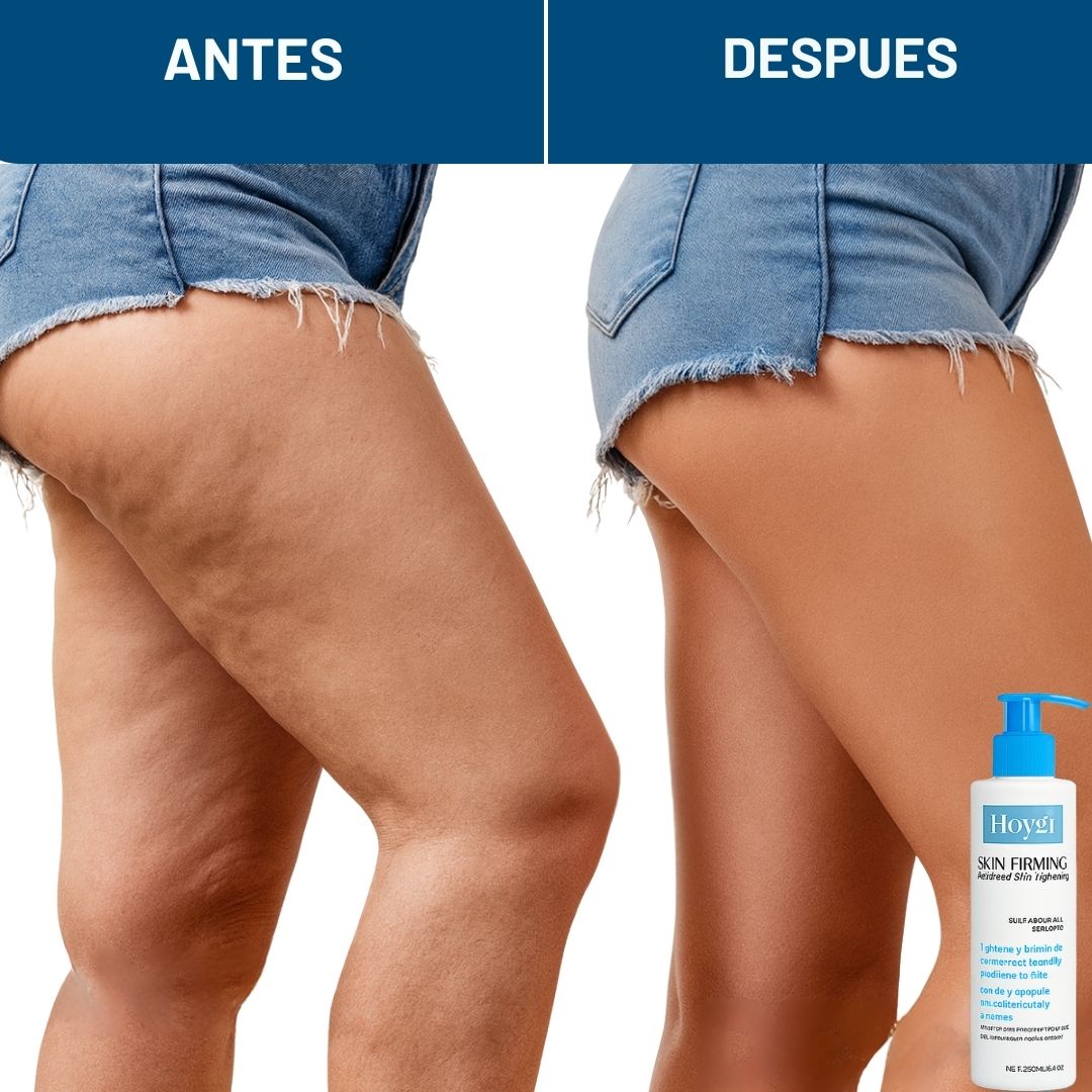 Crema Hoygi®-Combate la celulitis y piernas flacidas